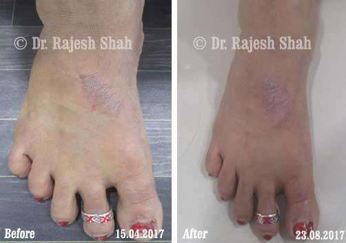 Psoriasis Before and After Case Photo