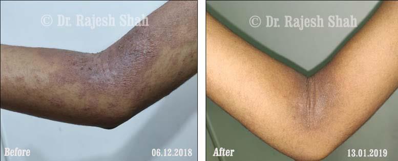 Atopic Dermatitis Before and After Case Photo
