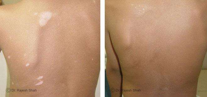 Vitiligo
