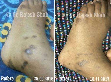 Lichen Planus Before and After Case Photo