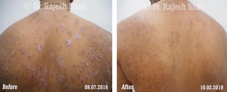 Psoriasis Before and After Case Photo