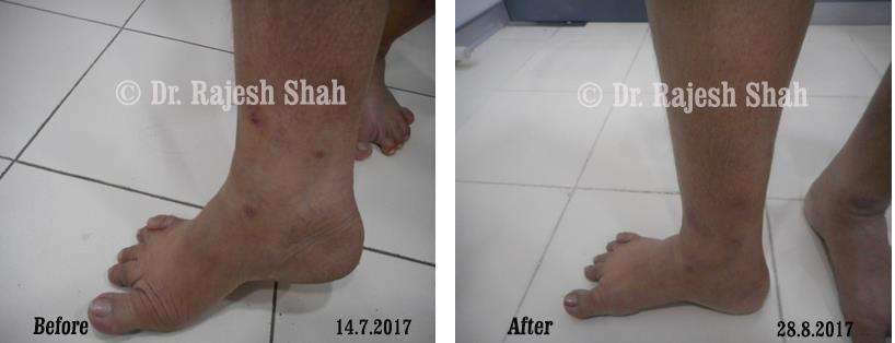 Atopic Dermatitis Before and After Case Photo