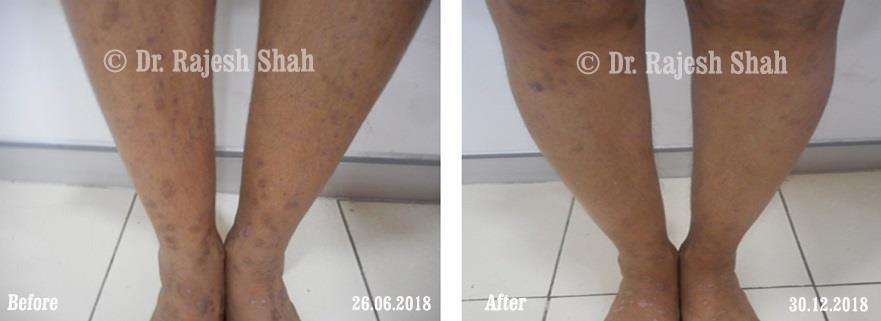 Lichen Planus Before and After Case Photo