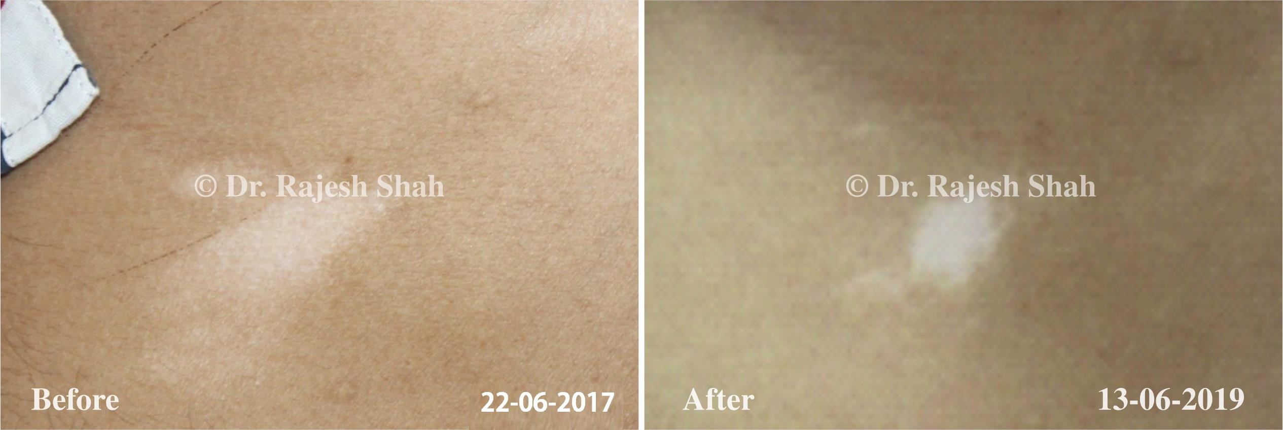Vitiligo Before and After Case Photo