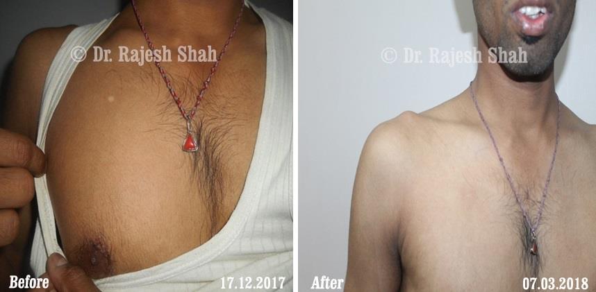 Vitiligo Before and After Case Photo