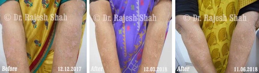 Psoriasis Before and After Case Photo