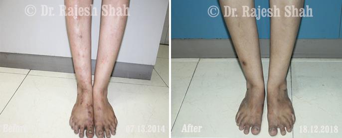 Psoriasis Before and After Case Photo