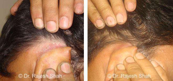 Psoriasis Before and After Case Photo