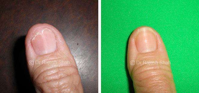 Lichen Planus Before and After Case Photo