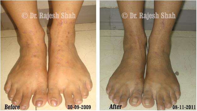 Lichen Planus Before and After Case Photo