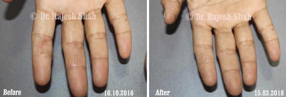 Psoriasis Before and After Case Photo