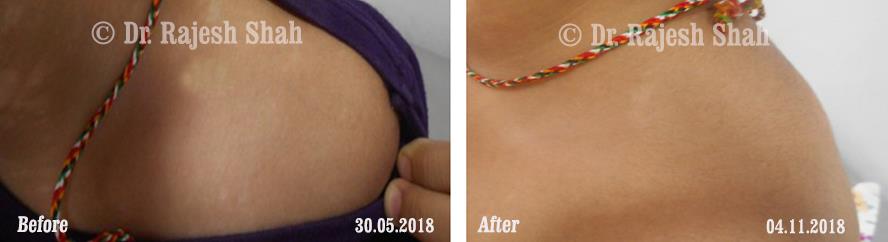 Vitiligo Before and After Case Photo