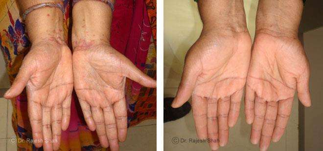 Lichen Planus Before and After Case Photo