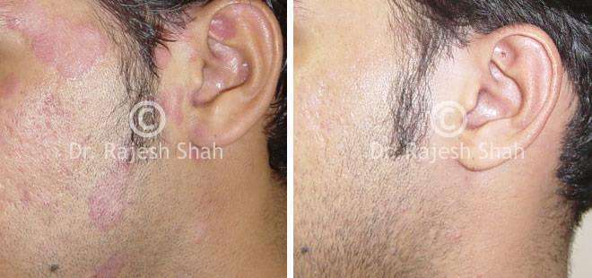 Psoriasis Before and After Case Photo