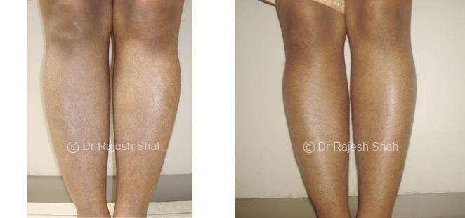 Lichen Planus Pigmentosa Before and After Case Photo