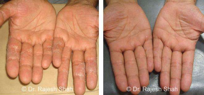 Psoriasis Before and After Case Photo