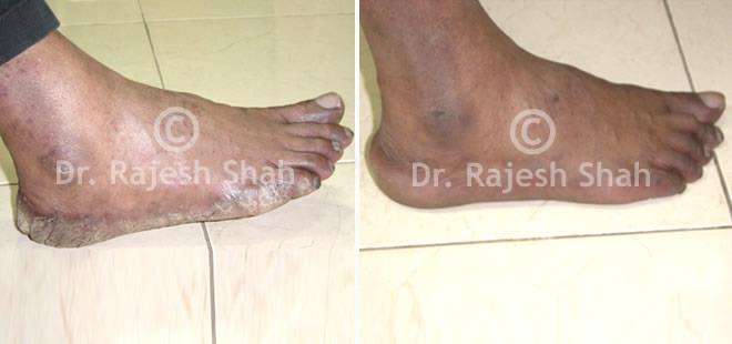 Psoriasis Before and After Case Photo