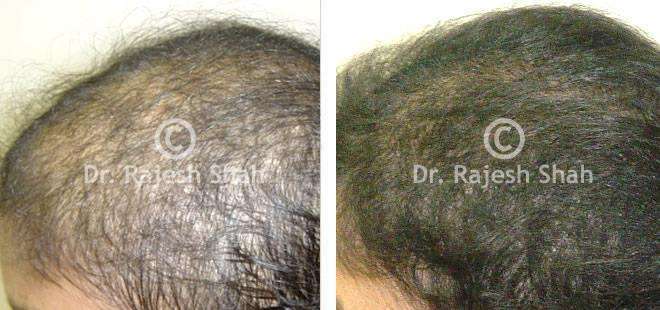 Hair loss Before and After Case Photo