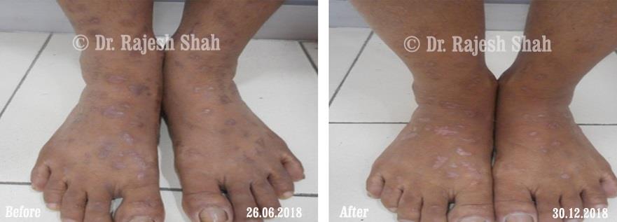 Lichen Planus Before and After Case Photo