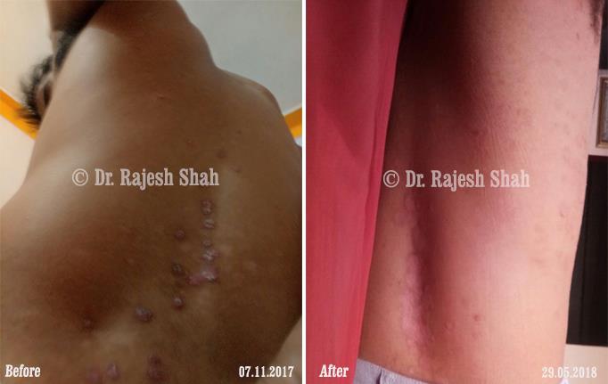 Psoriasis Before and After Case Photo