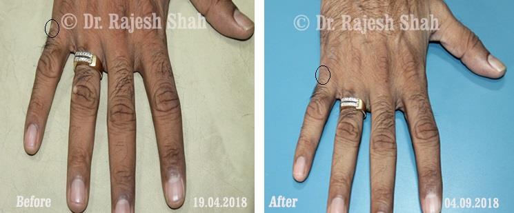 Vitiligo Before and After Case Photo