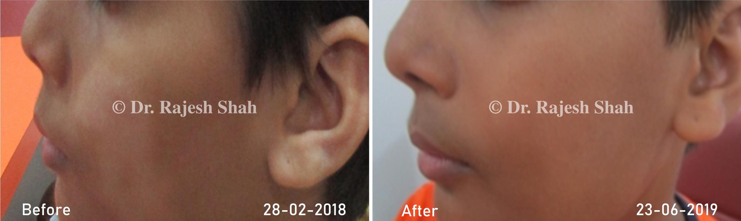 Pityriasis Alba Before and After Case Photo