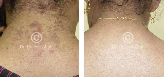 Lichen Planus Before and After Case Photo