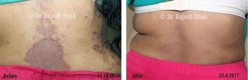 Psoriasis Before and After Case Photo