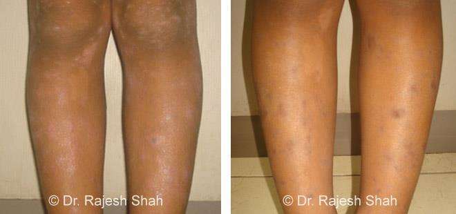 Lichen Planus Before and After Case Photo