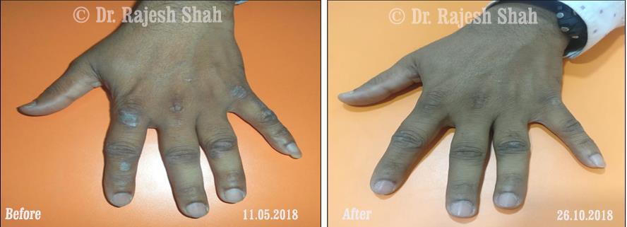 Psoriasis Before and After Case Photo