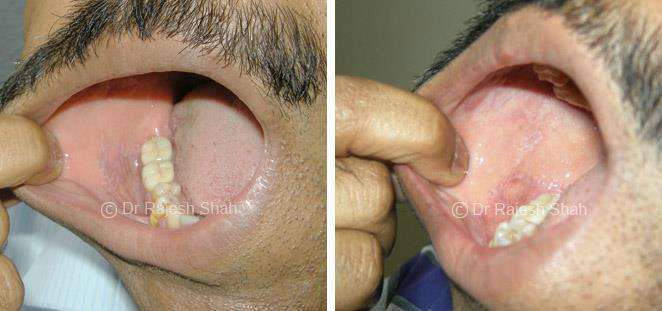 Lichen Planus Before and After Case Photo