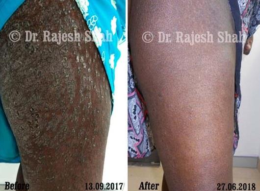 Psoriasis Before and After Case Photo