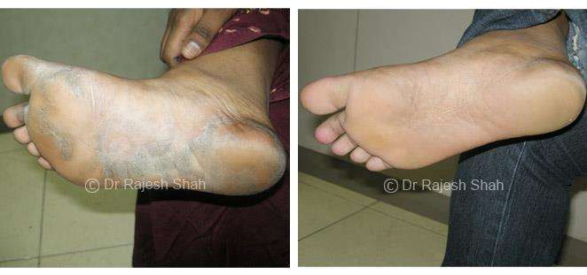 Psoriasis Before and After Case Photo