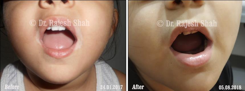 Vitiligo Before and After Case Photo