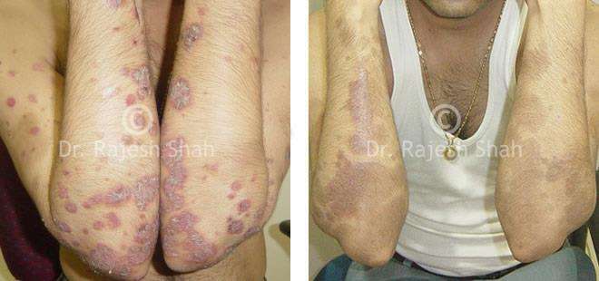 Psoriasis Before and After Case Photo