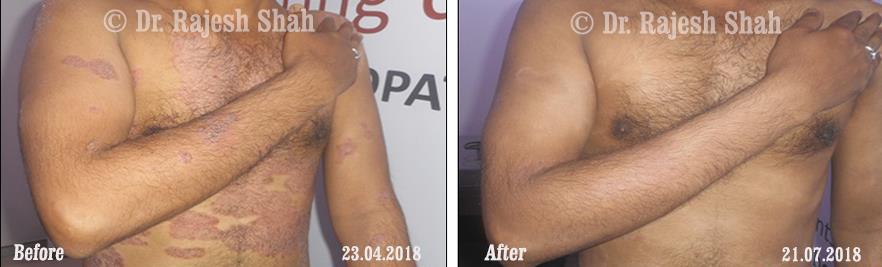 Psoriasis Before and After Case Photo