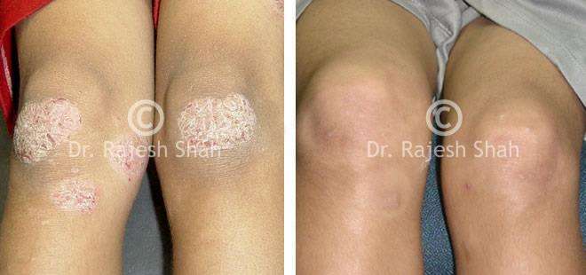 Psoriasis Before and After Case Photo