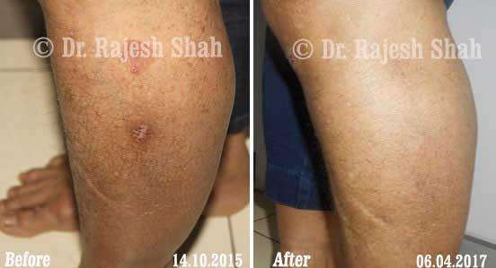 Granuloma Annulare Before and After Case Photo