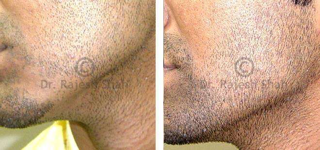 Alopecia Areata Before and After Case Photo