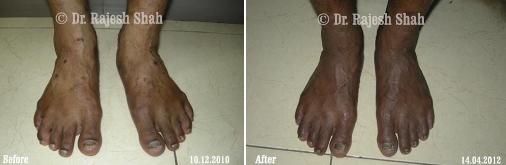 Lichen Planus Before and After Case Photo