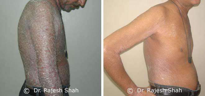 Psoriasis Before and After Case Photo