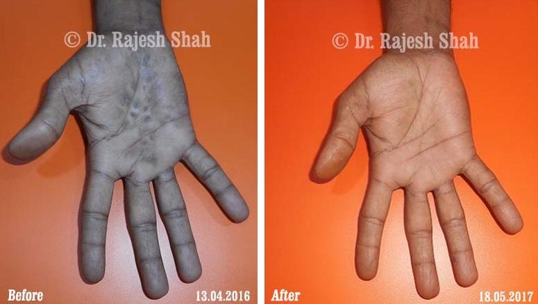 Psoriasis Before and After Case Photo