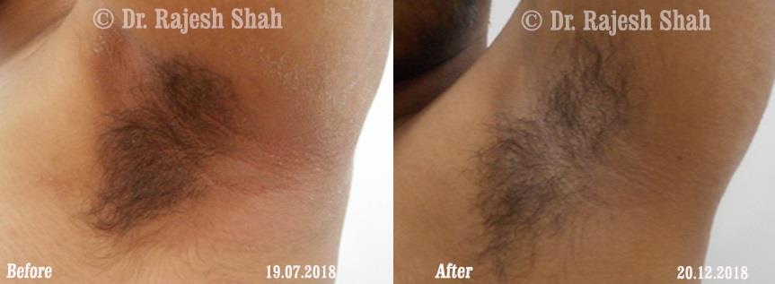 Atopic Dermatitis Before and After Case Photo