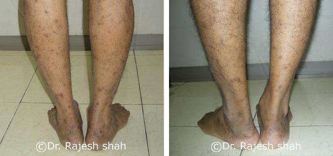 Psoriasis Before and After Case Photo