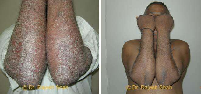 Psoriasis Before and After Case Photo