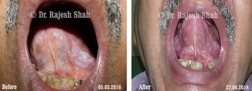 Lichen Planus Before and After Case Photo