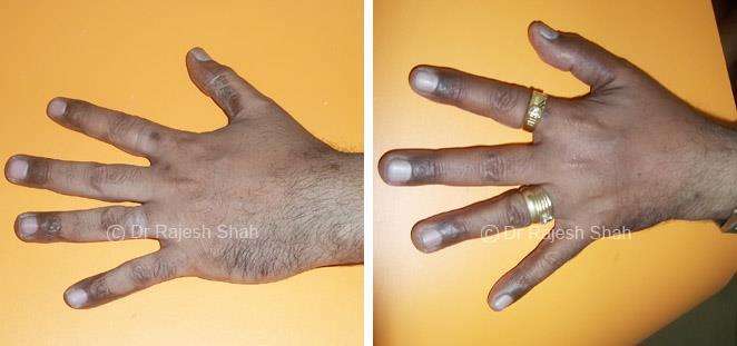 Psoriasis Before and After Case Photo