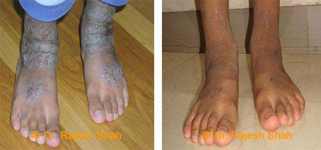 Eczema Before and After Case Photo