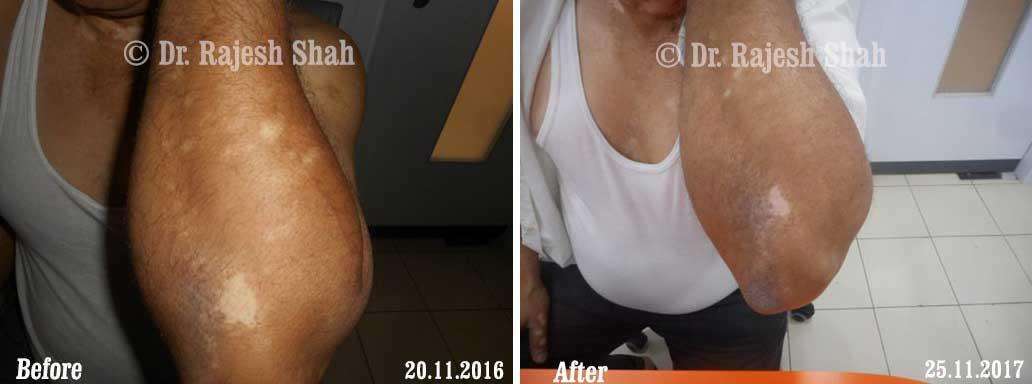 Vitiligo Before and After Case Photo