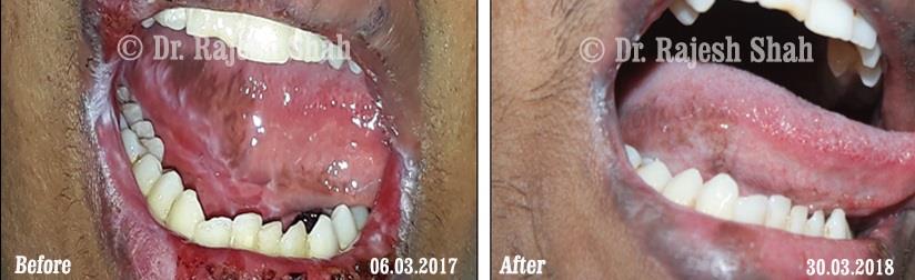 Lichen Planus Before and After Case Photo
